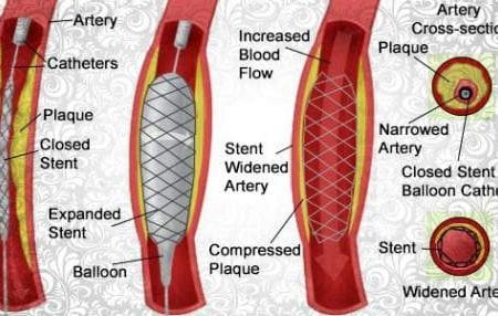 angioplasty