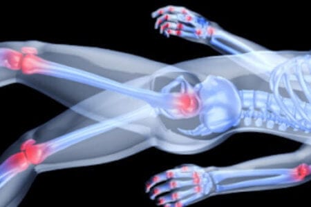 Arthritis