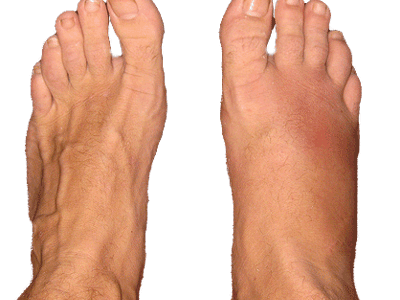 Foot Fracture
