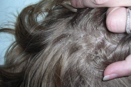 Dandruff