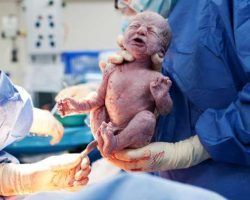 baby-being-born-via-caesarean-section
