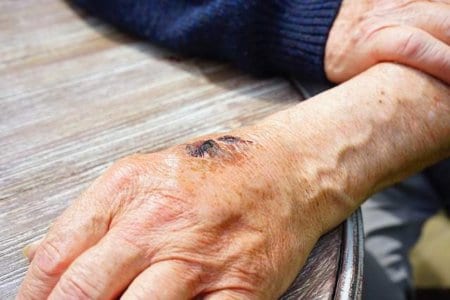 hand-injury-skin-abrasion-gall