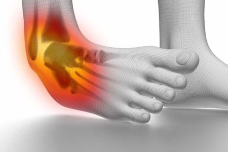 ankle-sprain