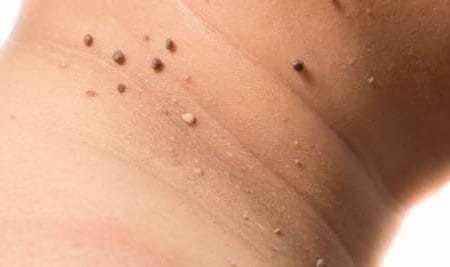 Skin Tags