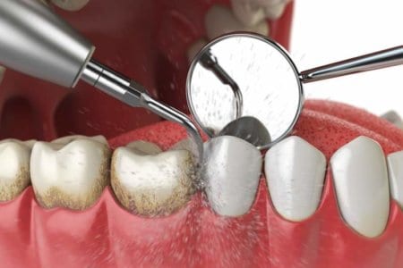 professional-teeth-cleaning-ultrasonic-teeth