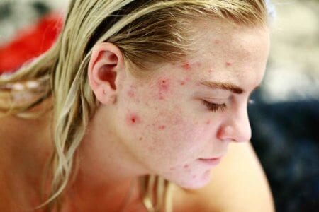 struggle-acne-self-love-skin-face