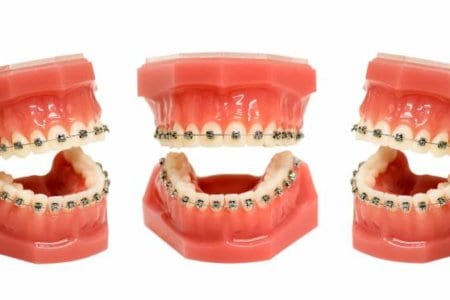 teeth-model-with-wired-dental-braces