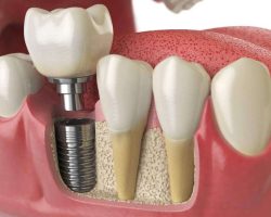 anatomy-of-healthy-teeth-and-tooth-dental-implant