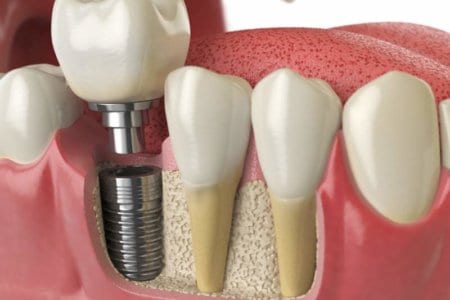 anatomy-of-healthy-teeth-and-tooth-dental-implant